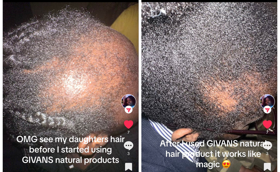 Causes Of Alopecia